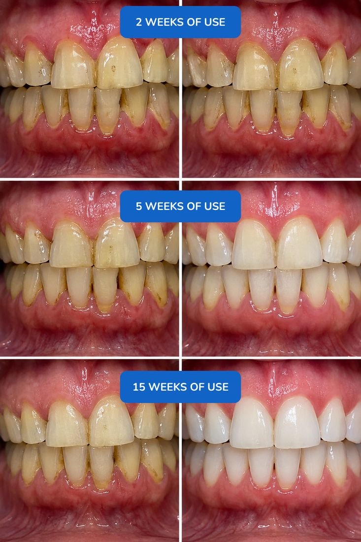 Real customer teeth progress at 2, 5, and 15 weeks of DentaBiome use